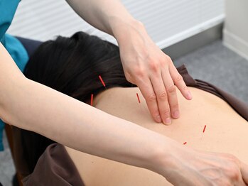 エド鍼灸院 日本橋(EDO鍼灸院)/首肩の鍼