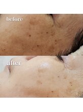 ピアーノ(PIANO)/エルモサハーブピーリング