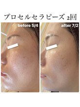 リードスラッシュ(LEAD/)/プロセルセラピーズお顔