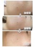 HITOYURAIエクソソーム導入＆高保湿パック＆首肩デコルテハンド  13500円