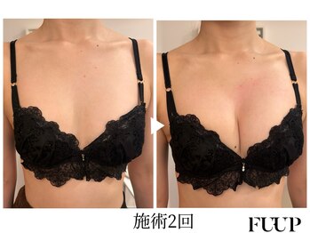 フーアップ 北千住(FU-UP)/バストアップ/育乳（2回）