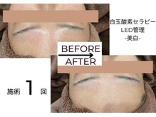 ベガ(Vega)/白玉酸素セラピーLED