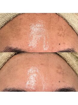 スペチアーレ 夙川/REVIハーブピーリングで陶器肌に