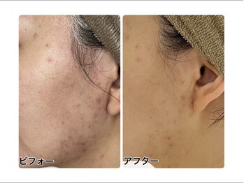 アンジェーム(angeame)/ニキビケアおまかせください♪