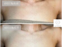 ラヴィオーラ 川西(La Viora)/ダイヤモンドハーブピーリング