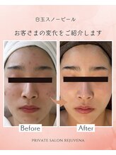 リジュベネ(rejuvena)/【白玉スノーピール効果写真】