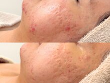 ニコレ(Nicore)/ニキビケア/赤み