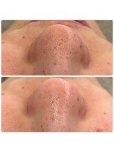 ネオファースト 大阪福島店(NeoFirst)/毛穴の黒ずみ撲滅！#毛穴吸引