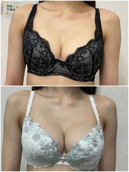 バーディー(BIRDIE)/施術９カ月/２０代/C→Eカップ