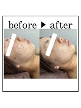 ザ カリビア(The CAREBEA)/BBL光フェイシャル