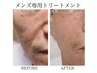 メンズ専用クーポン◆目指せモテ肌/髭脱毛＋毛穴引き締め美肌コース