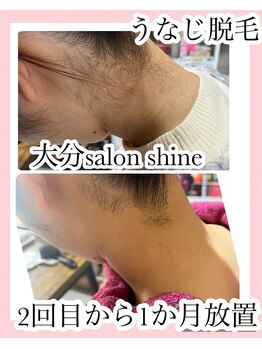 サロンシャイン(Salon Shine)/うなじ脱毛の効果