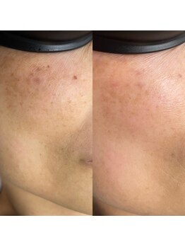 シャルム(Charme)/Eライトフェイシャル効果