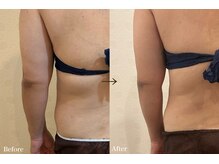 ラシュシュ(La chou chou)/脂肪冷却/痩身/筋膜リリース