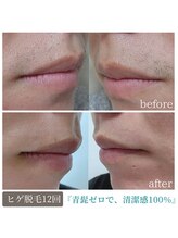 ティンクル サロン(Twinkle salon)/鼻下、口下の脱毛