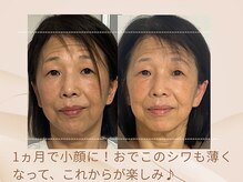 美カナエル(美kanaeru)/1ヵ月目の変化に驚き