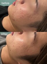 ベル 静岡(Belle)/静岡/ハーブピーリング/毛穴