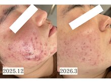 アエオボンヌール(A.E.O BONHEUR)の雰囲気（ニキビは身体からのSOS！体質から整えるニキビ改善）