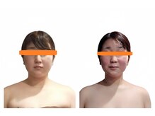 サララ(Salala)/地下鉄赤塚 筋膜小顔矯正 たるみ