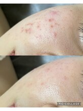 トーニングルーム(Toning room)/光フェイシャルでニキビケア