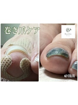 爪の悩みを解消できる（ケア含む）