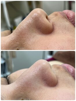 シュウ(Shuu)/毛穴洗浄のビフォーアフター