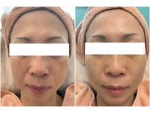 リッツ ひばりが丘パルコ店/【Before/After】シミ改善