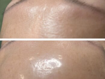 コハク(kohaku)/皮剥けなしハーブトリートメント