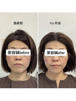 ハリサロンドオフ 堺東店(hari salon de off)/お客様before→after