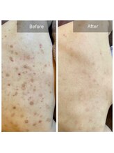 ビビ(VIVI)/背中ニキビケアハーブピーリング