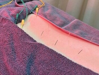えん鍼灸院 整骨院の写真/宇都宮市で評判高い鍼専門院。深層部の悩みに応える専門施術