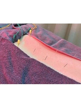 鍼灸施術を受けたい