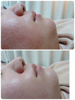 プトゥリ(Putri)/フェイシャル脱毛