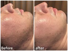 ボヌールデソワ(Bonheur de Soi)/ハーブピーリング　