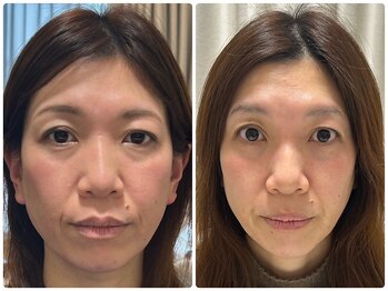 ラピスラズリの写真/美肌×小顔が同時に叶うエイジングケア&リフトアップ★水光導入レッドショットでたるみ/ほうれい線集中ケア