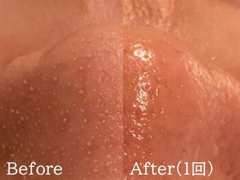 ルナステラ 金沢店/ハイドロ毛穴洗浄