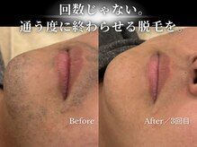 ダイヤ 名古屋中川区店(Daiya)/3回で濃かった髭が激変！横から
