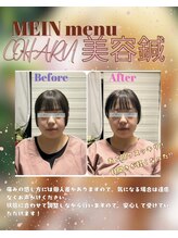 コハル鍼灸整骨院 本郷三丁目(COHARU鍼灸整骨院)/美容鍼☆ Before After