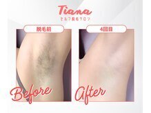 ティアナ 水戸店(Tiana)の雰囲気（セルフでも数回でツルツルに！(セルフ脱毛/全身脱毛/VIO脱毛））