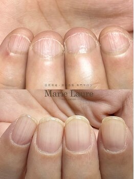 マリーロール 梅田店(Marie Laure)/自爪育成/深爪矯正/ネイルケア