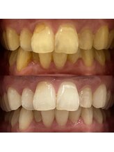 ハリス(HARIS)/セルフホワイトニング