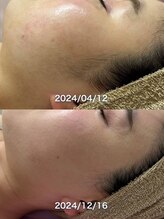 サロンドジェシカ(salon de Jessica)/お顔脱毛/もみあげも整えます