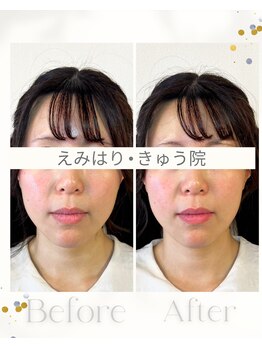 えみはりきゅう院/リフトアップ