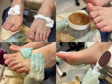 メンズフット角質ケア