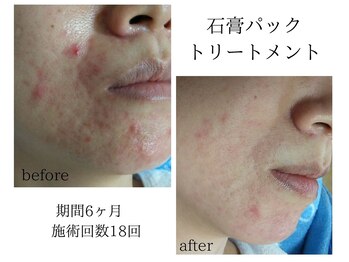 りりあす/マスクによる隠れたトラブル