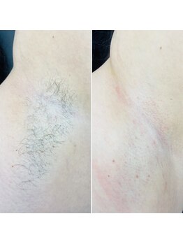 ヴィテラス バイ アリア(Veteras by aria)/☆脱毛☆