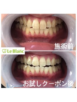 ルブラン 奈良店(Le Blanc)/初回!驚きの効果です!!