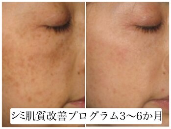 ヌー 栄(nuu)/シミ肌質改善プログラム3～6か月
