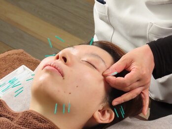 イーグル整骨院 幸町店の写真/【フェイシャル美容鍼￥5500】SNSやTVで今話題沸騰の美容鍼◎お悩み箇所のツボを刺激し不調改善&血行促進!
