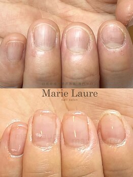 マリーロール 天王寺店(Marie Laure)/深爪矯正/自爪育成/ネイルケア